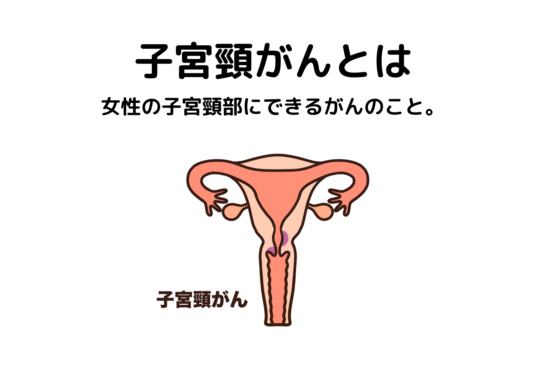 30歳、子宮頸がん検診に行ってきました。 小児乾癬ブログ