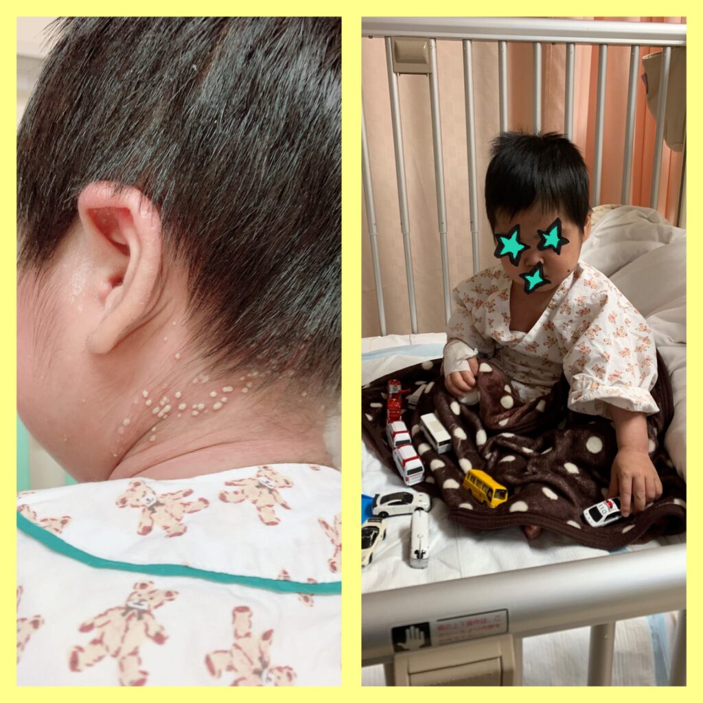 膿疱性乾癬の息子‗入院２－３
